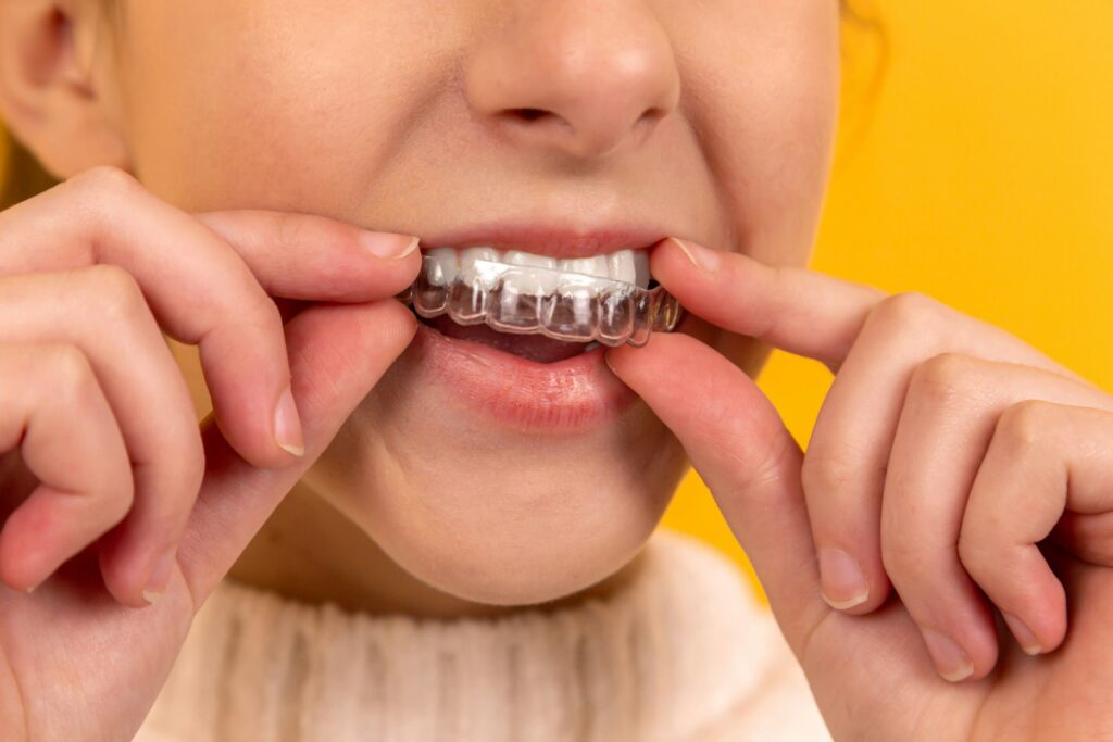 Scopri la guida completa per conoscere il mondo degli apparecchi ortodontici dedicati ai bambini.