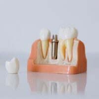 Corona dentale: la guida completa