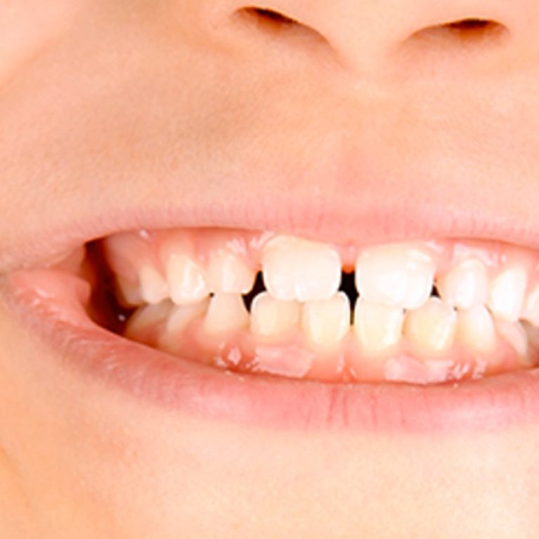immagine-denti-da-latte
